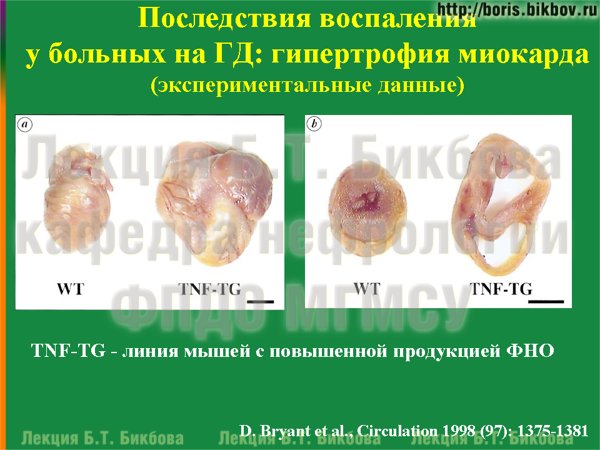 Последствия воспаления у больных на гемодиалзе: гипертрофия миокарда