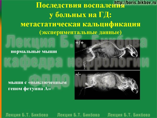 Последствия воспаления у больных на гемодиалзе: метастатическая кальцификация