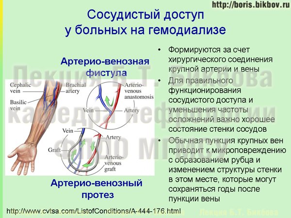 Сосудистый доступ на гемодиализе - артерио-венозная фистула и артерио-венозный сосудистый протез Сосудистый доступ на гемодиализе - артерио-венозная фистула и артерио-венозный сосудистый протез