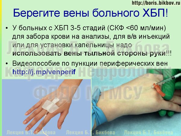 Техника венепункции у больных с ХБП 3-5 стадий (при скорости клубочковой фильтрации 60 мл/мин и менее) Правильная техника венепункции у больных с ХБП (при скорости клубочковой фильтрации 60 мл/мин и менее)