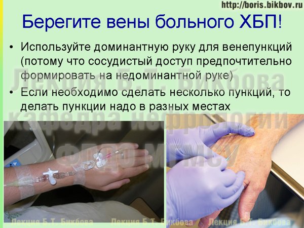 Техника венепункции у больных с ХБП при сниженной СКФ Правильная техника пункции вен у больных при хронической болезни почек со сниженной скоростью клубочковой фильтрации